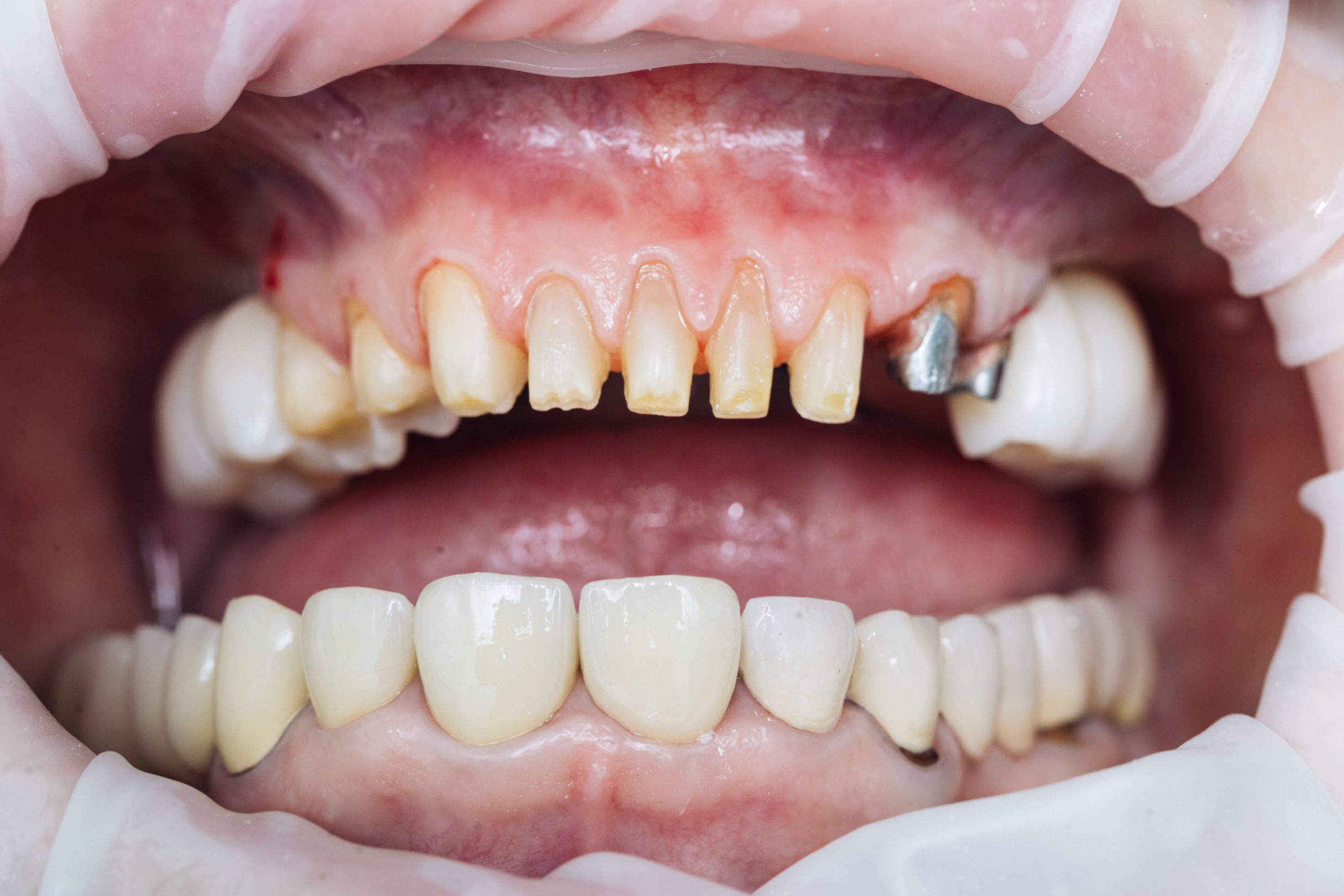Are Veneers Permanent? Everything You Need To Know pertaining to Marquetry Furniture Care