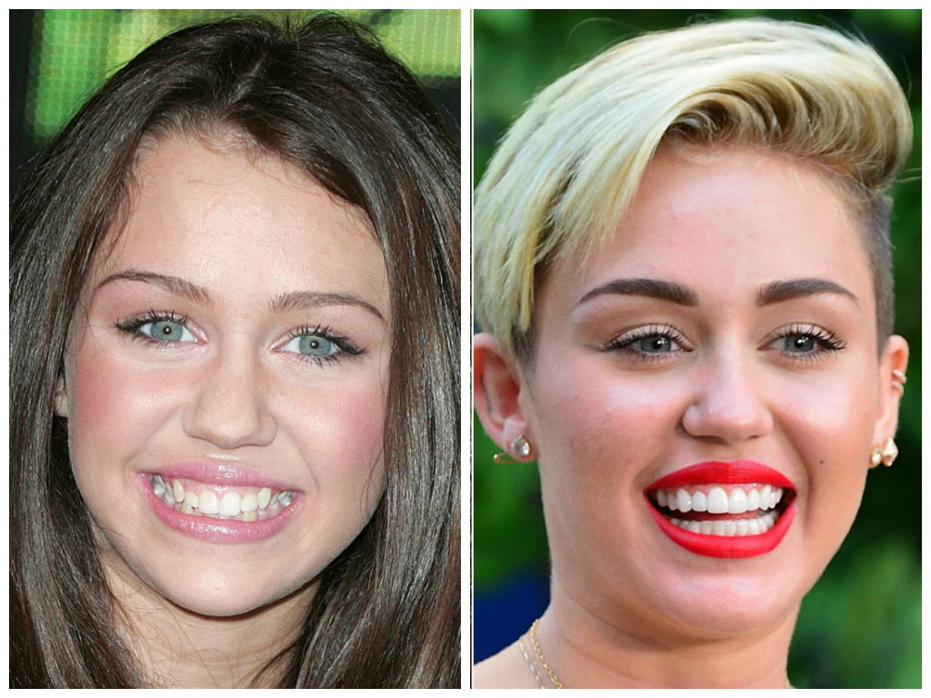 Do All Celebrities Have Veneers? Your Personal Guide On Hollywood Smile within How to Spot Early Signs of Veneer Lifting and Fix Them Before They Spread