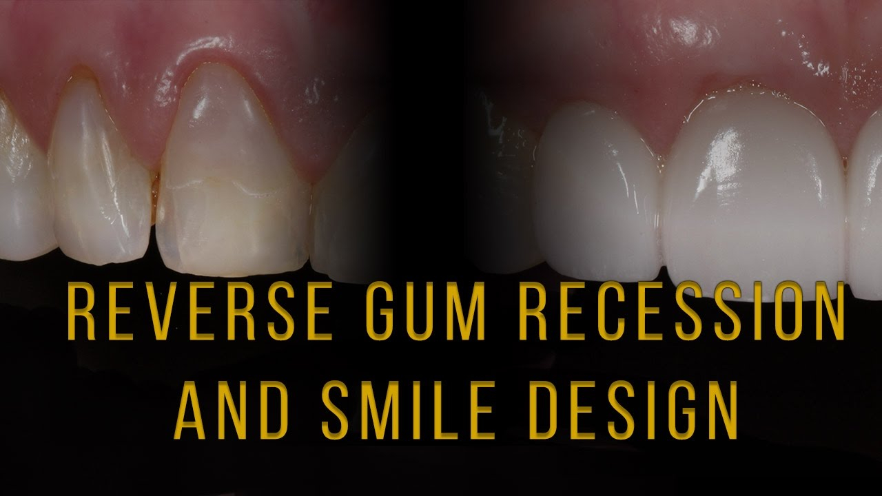 How To Get Gum Recession Back And Improve Your Smile With Porcelain ... throughout Marquetry Furniture Care