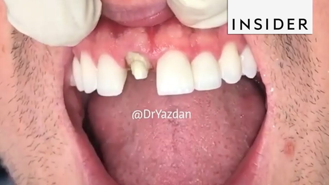 How To Tell Real Veneer At Joanne Mattes Blog throughout How to Spot Early Signs of Veneer Lifting and Fix Them Before They Spread